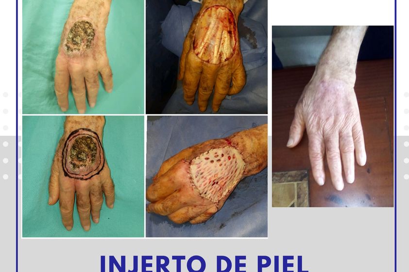 Carcinoma Basocelular antes y después - 688098