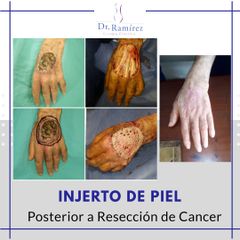 Injerto en dorso de mano - Dr. Edgar Ramírez López