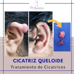 Cicatriz queloide - Dr. Edgar Ramírez López