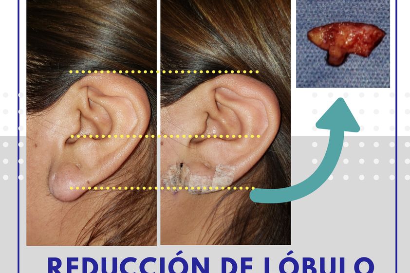 Otoplastia antes y después - 688102
