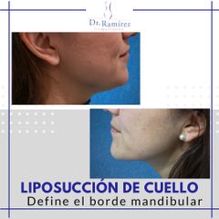 Liposuccion de cuello - antes y después
