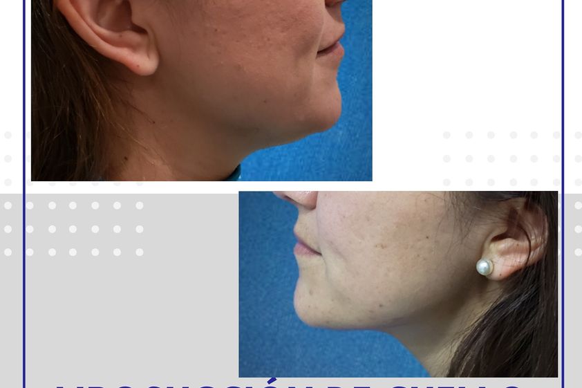 Liposucción antes y después - 689742