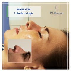 Rinoplastia - antes y después