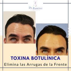 Botox - antes y después