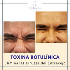 Bótox - antes y después