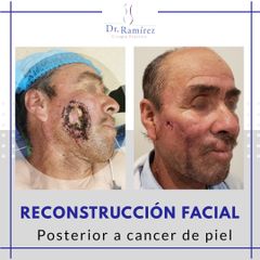 Reconstrucción facial - antes y despés
