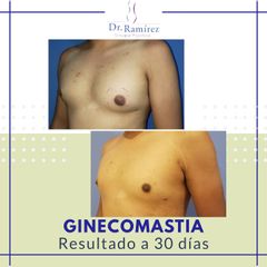 Ginecomastia - Dr. Edgar Ramírez López