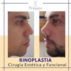 Rinoplastia en Hombre - Dr. Edgar Ramírez López