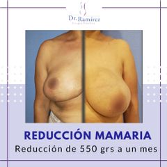 Gigantomastia - Dr. Edgar Ramírez López