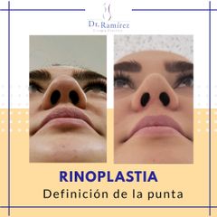 Rinoplastia Basal