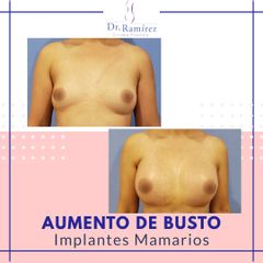 Aumento de busto