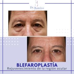 Blefaroplastia hombre - Dr. Edgar Ramírez López