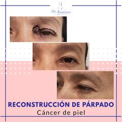 Carcinoma en parpado superior - Dr. Edgar Ramírez López