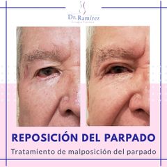 Corrección de Ectropión