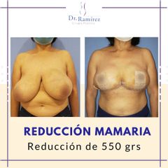 Reducción mamaria Inmediato - Dr. Edgar Ramírez López