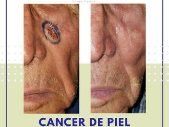 Carcinoma Basocelular antes y después - 737527