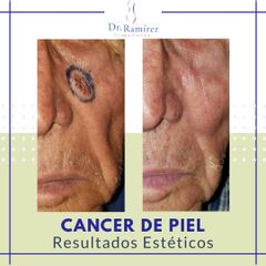 Carcinoma Mejilla - Dr. Edgar Ramírez López