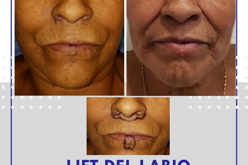 Lifting antes y después - 737528