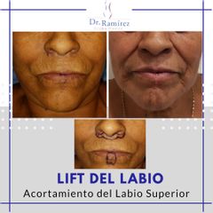 Lift de labio - Dr. Edgar Ramírez López