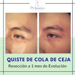 Quiste cola de ceja - Dr. Edgar Ramírez López