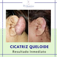 Queloide de oreja - Dr. Edgar Ramírez López