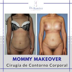 Mommy MakeOver - Dr. Edgar Ramírez López
