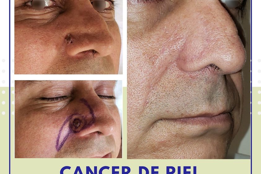 Carcinoma Basocelular antes y después - 737536