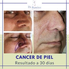 Carcinoma en ala nasal  - Dr. Edgar Ramírez López
