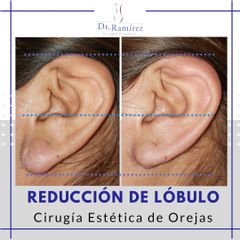Reducción de lóbulo de oreja -  Dr. Edgar Ramírez López