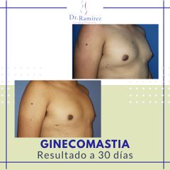 Ginecomastia - Dr. Edgar Ramírez López