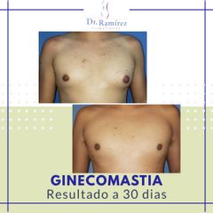 Ginecomastia - Dr. Edgar Ramírez López