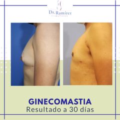 Ginecomastia - Dr. Edgar Ramírez López