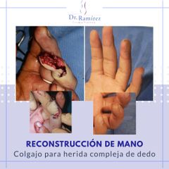 Reconstrucción punta dedo - Dr. Edgar Ramírez López