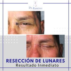 Resección de lunares - Dr. Edgar Ramírez López