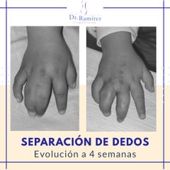Separación de dedos - Dr. Edgar Ramírez López