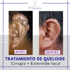 Queloide de oreja - Dr. Edgar Ramírez López