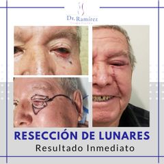 Resección de lunares - Dr. Edgar Ramírez López