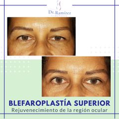 Blefaroplastia superior - Dr. Edgar Ramírez López