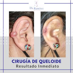 Queloide de oreja - Dr. Edgar Ramírez López