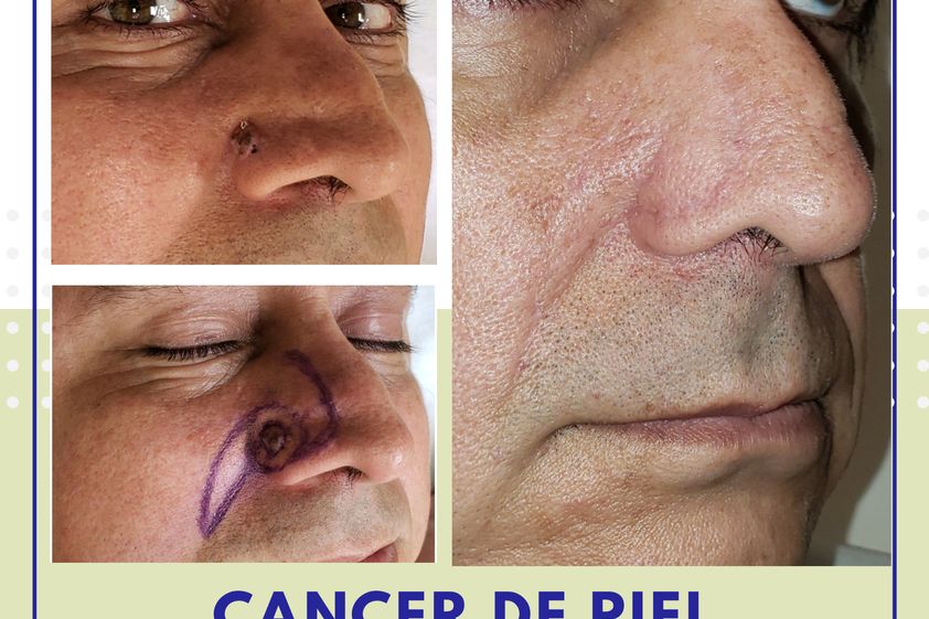 Carcinoma Basocelular antes y después - 739945