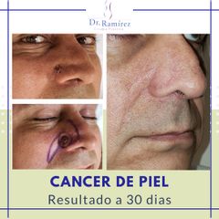 Cancer de piel - Dr. Edgar Ramírez López