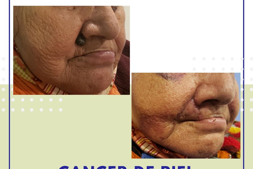 Carcinoma Basocelular antes y después - 740671