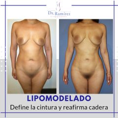 Lipoescultura - Dr. Edgar Ramírez López