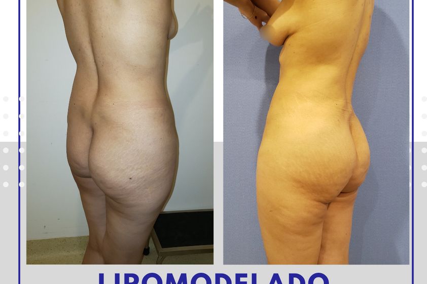 Gluteoplastia antes y después - 785878