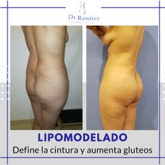Gluteoplastia - Dr. Edgar Ramírez López