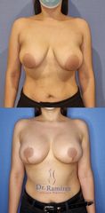 Mastopexia - Dr. Edgar Ramírez López