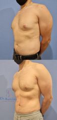 Lipoescultura alta definicion - Dr. Edgar Ramírez López