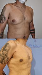 Ginecomastia - Dr. Edgar Ramírez López
