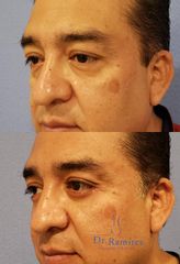 Blefaroplastia inferior - Dr. Edgar Ramírez López