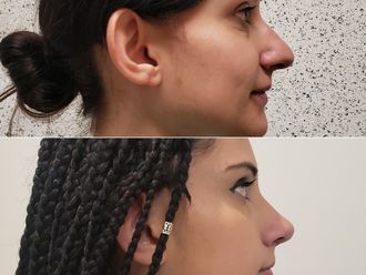 Rinoplastia antes y después - 873564